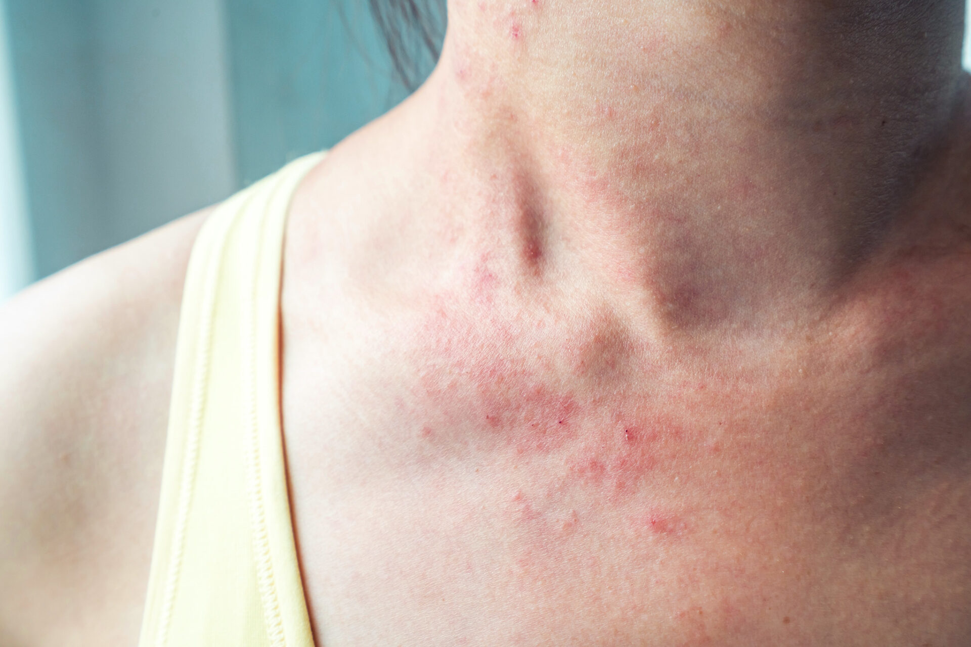 โรคพุ่มพวง โรคพุ่มพวง