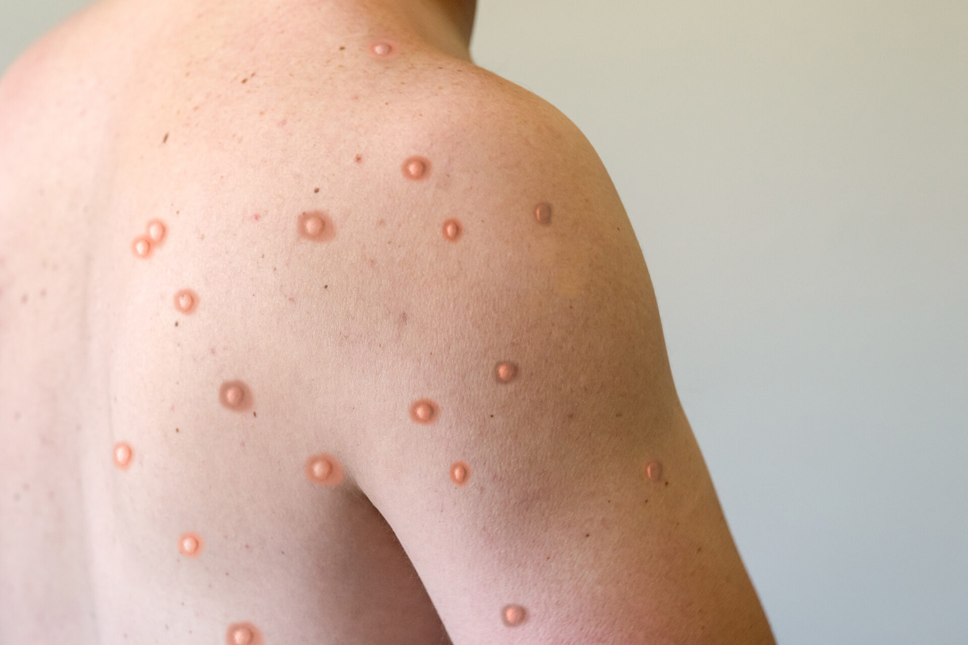 ระวังฝีดาษลิง ฝีดาษลิง