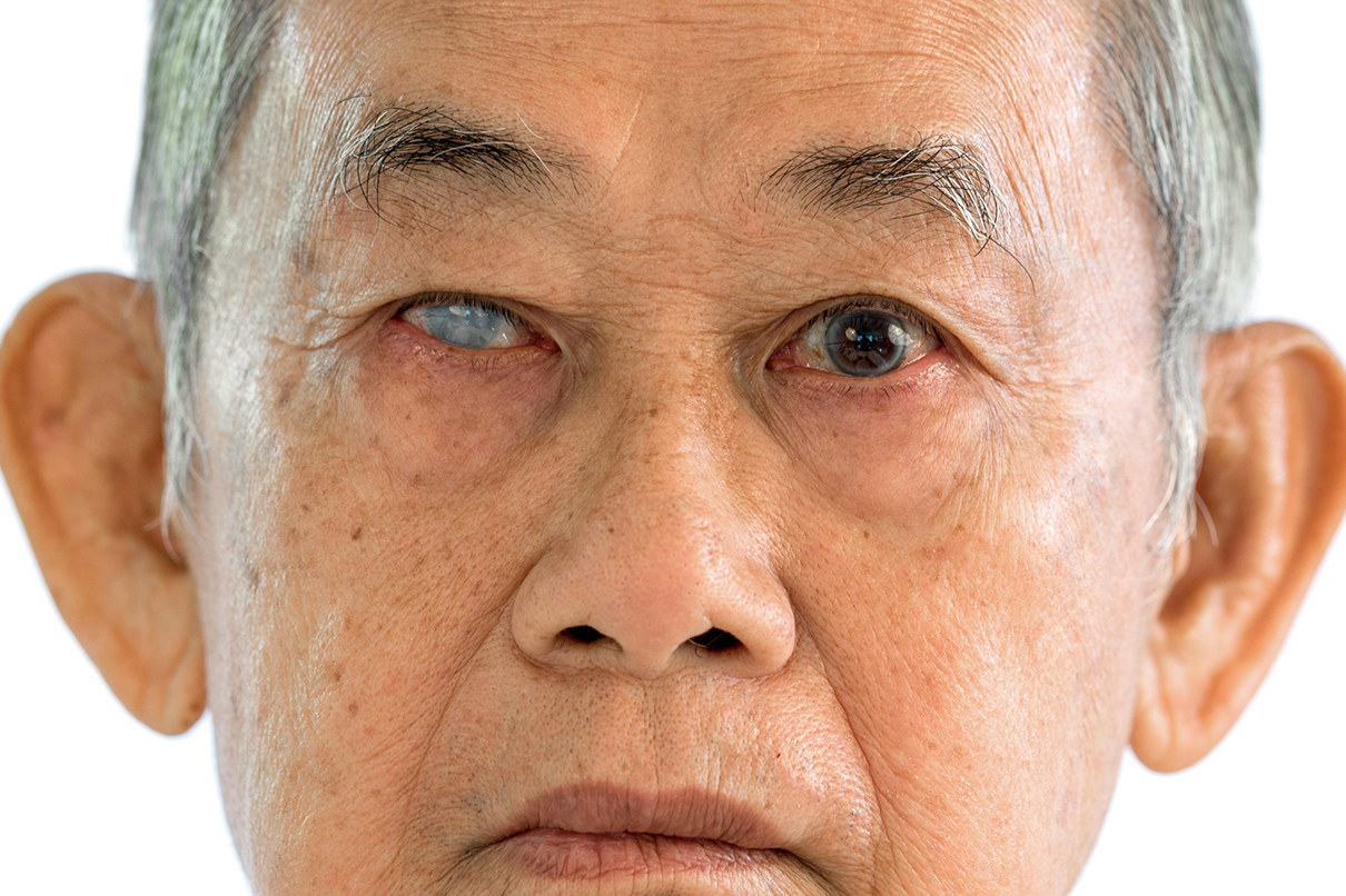 โรคต้อหิน โรคต้อหิน