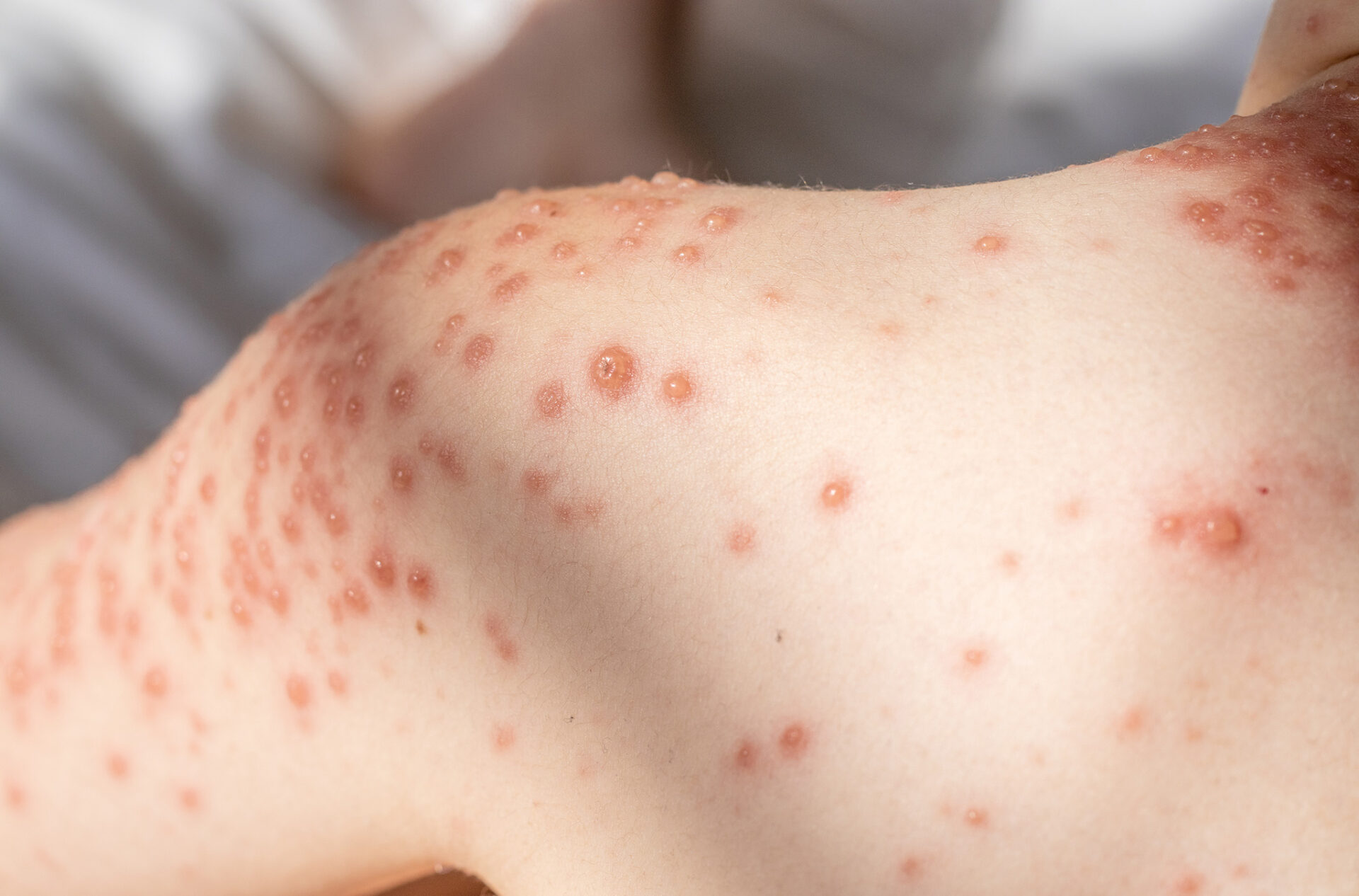 อีสุกอีใส